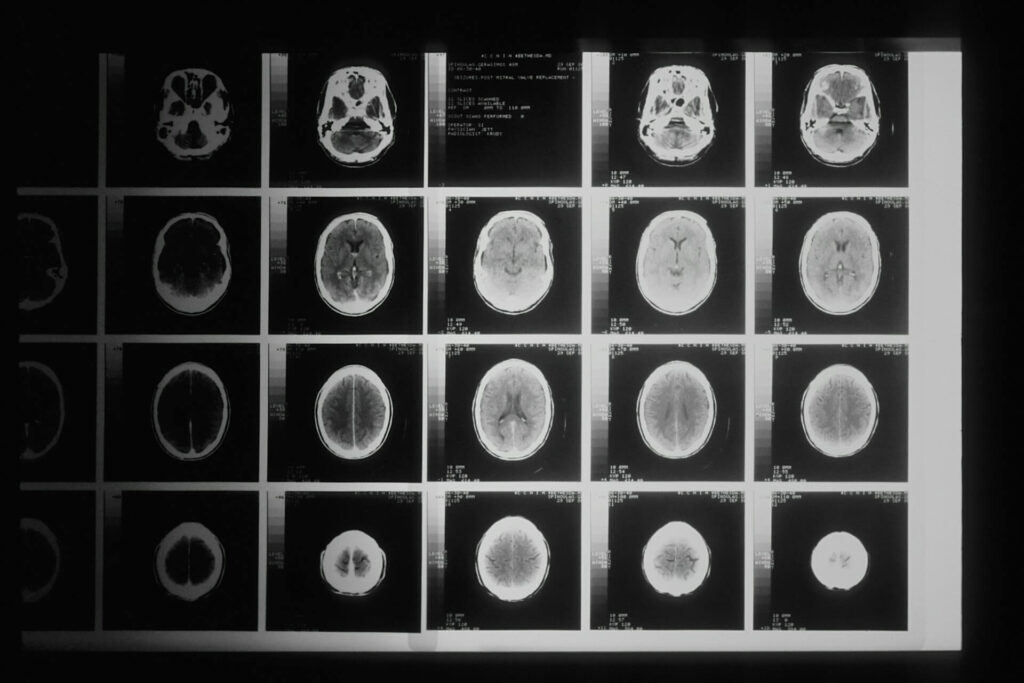 a brain scan image showing different scan slices after a trauamtic brain injury