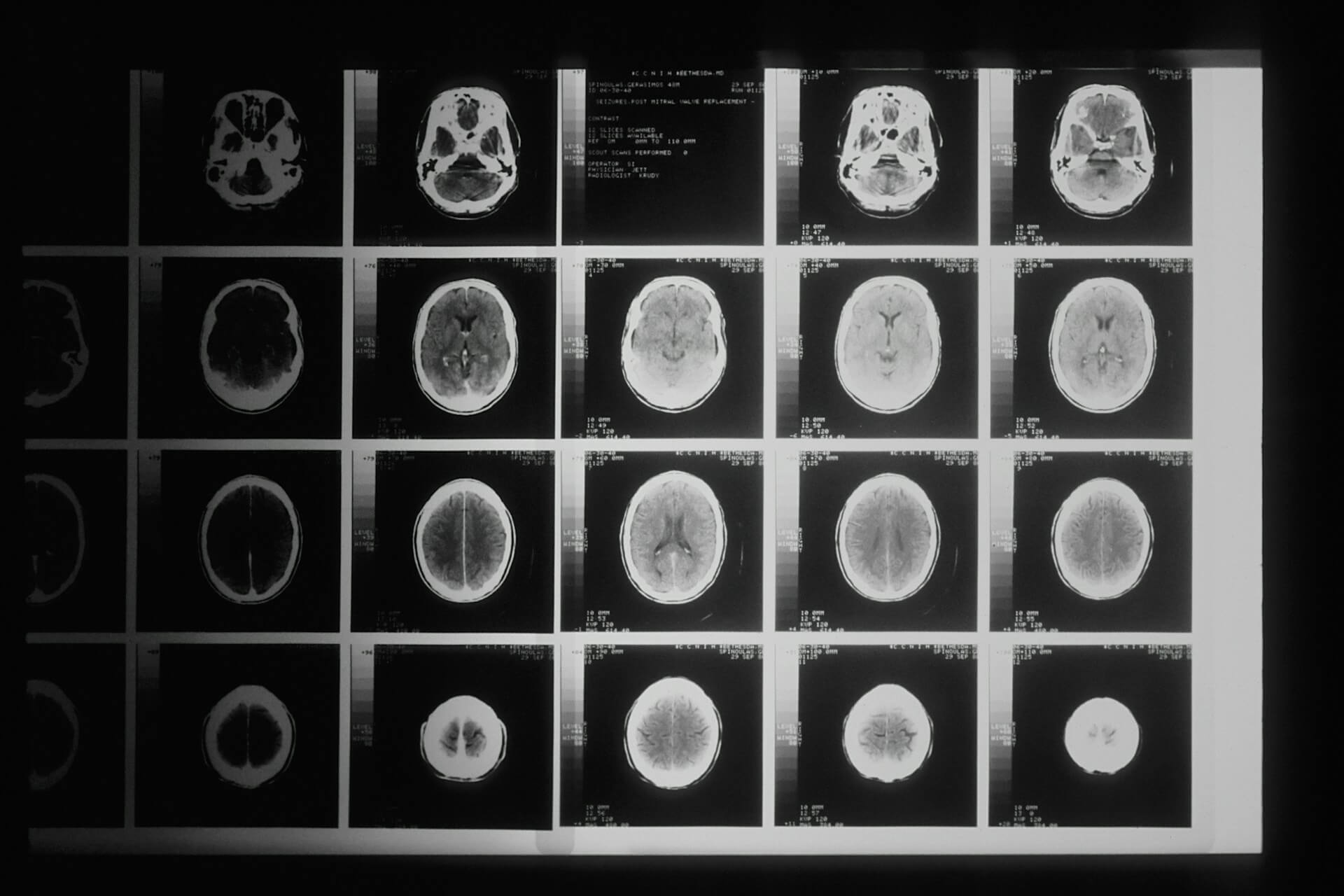 a brain scan image showing different scan slices after a trauamtic brain injury